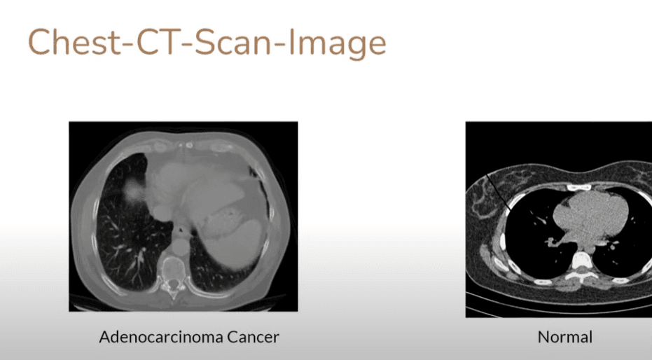 Adenocarcinoma Detection